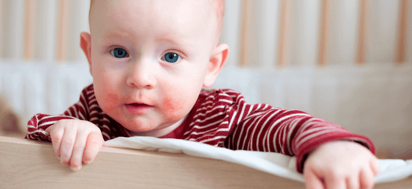 Лечение розацеа