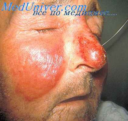 рожа и ее характеристика