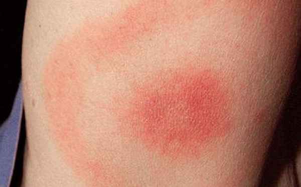 Причины рожистого воспаления