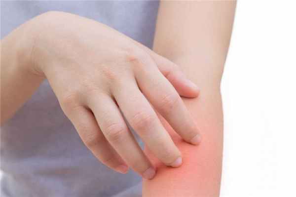 Рожистое воспаление (рожа)