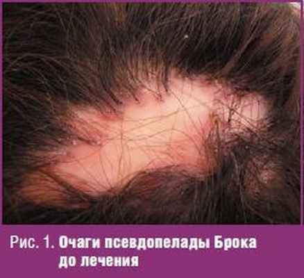 Очаги псевдопелады Брока до лечения