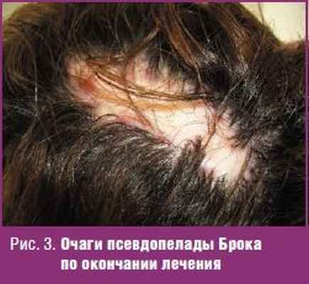 Очаги псевдопелады Брока по окончании лечения