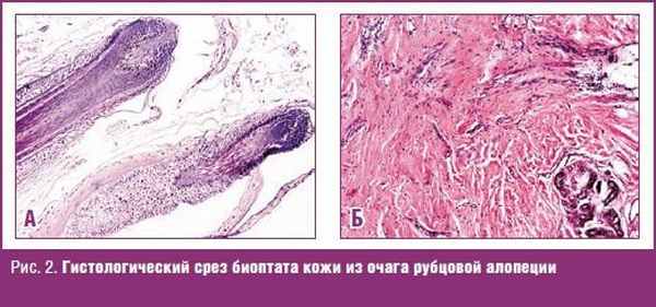 Гистологический срез биоптата кожи из очага рубцовой алопеции