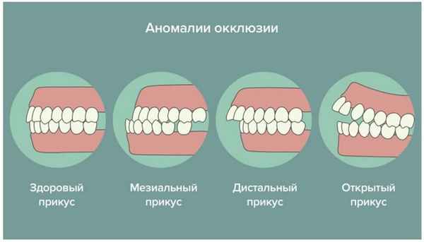 Фото правильного и неправильного прикуса