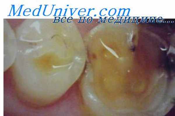 окклюзионная кривая