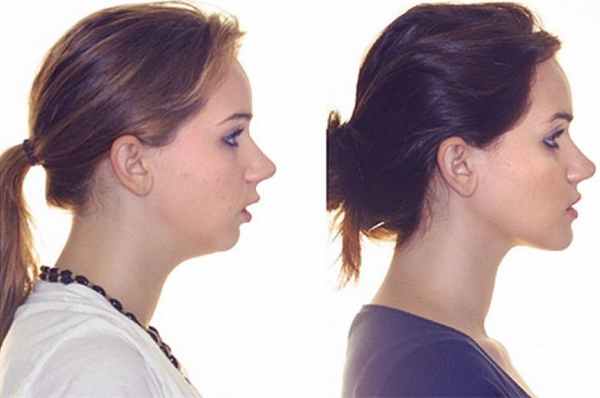 Дистальный прикус: фото до и после коррекции