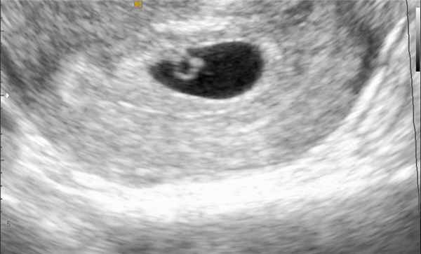 УЗИ-исследование угрозы выкидыша