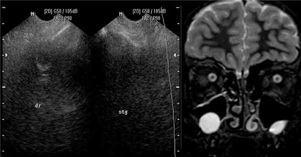 Рентген новообразований в гайморовой пазухе