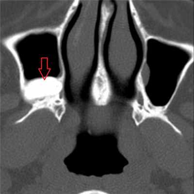 Рентген кисты в верхнечелюстном синусе