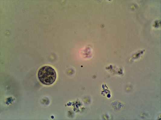 Дизентерийная амеба вызывает особую форму кровавого поноса — амебную дизентерию.