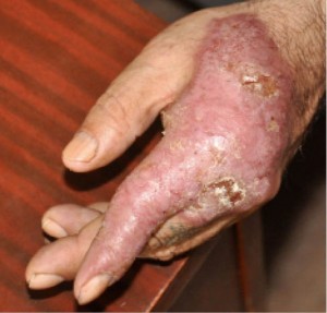 Рис. 1. Саркоидоз кожи в области левой кисти (здесь и далее – фото предоставлены автором)