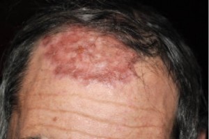 Рис. 3. Язвенно-атрофическая форма саркоидоза кожи в области лба