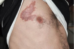 Рис. 4. Язвенно-атрофическая форма саркоидоза кожи в области туловища