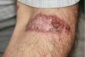 Рис. 5. Язвенно-атрофическая форма саркоидоза кожи левой верхней конечности