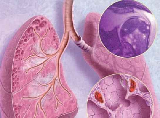 Саркоидоз легких