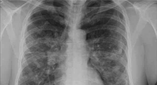 Стадии саркоидоза легких