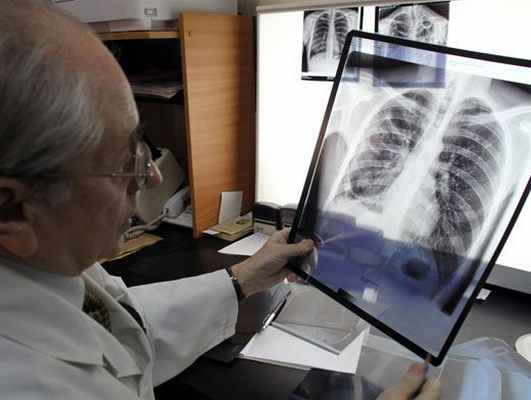 Диагностика саркоидоза легких