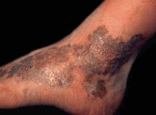 Идиопатическая саркома Капоши