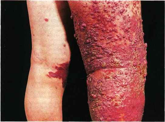 Иммуносупресивная саркома Капоши