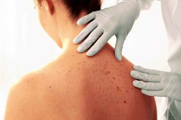 лечение саркомы Капоши