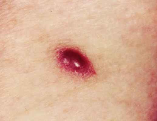 эпидемическая саркома Капоши