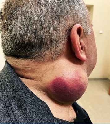 эндемический тип Капоши