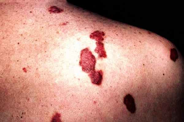 Саркома Капоши