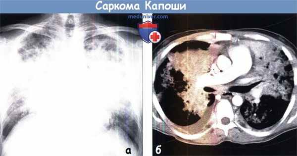 Саркома Капоши на рентгенограмме и КТ