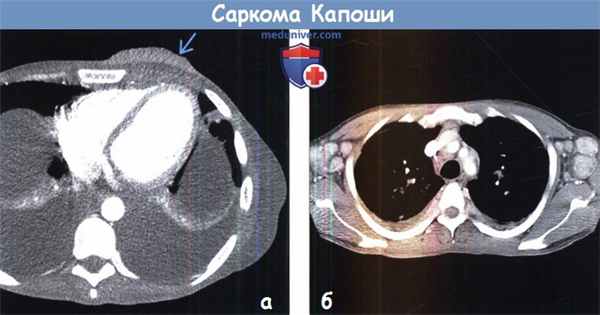 Саркома Капоши на КТ
