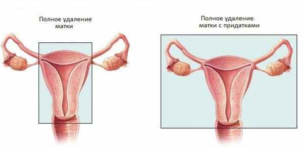 Варианты операций при саркоме матки