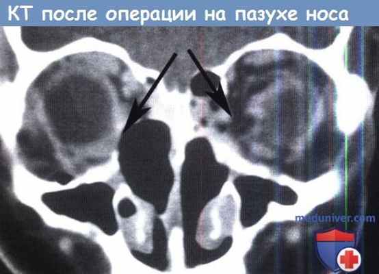 КТ после операции на пазухе носа