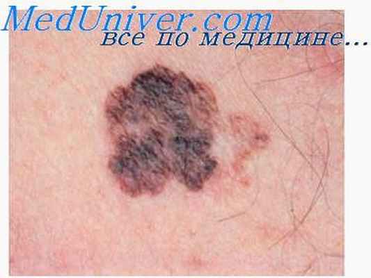 себорейная карцинома