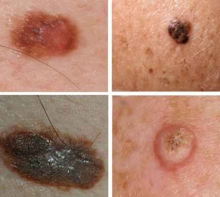 кератома кожи