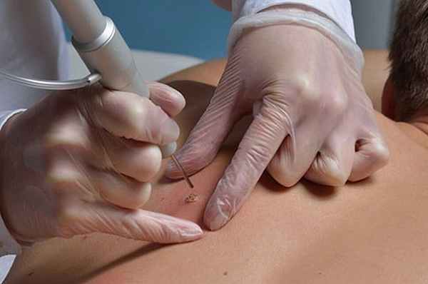 Удаление кератом