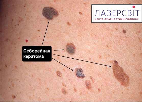 себорейная кератома на коже