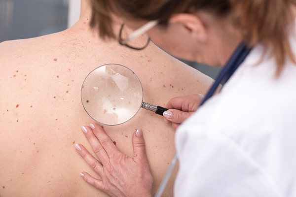 Возникновение кератопапиллом