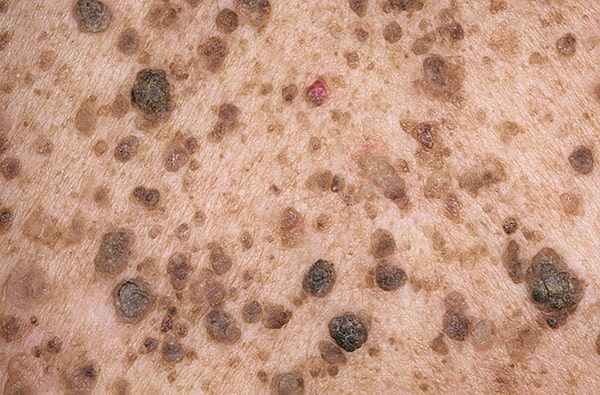 Себорейный кератоз