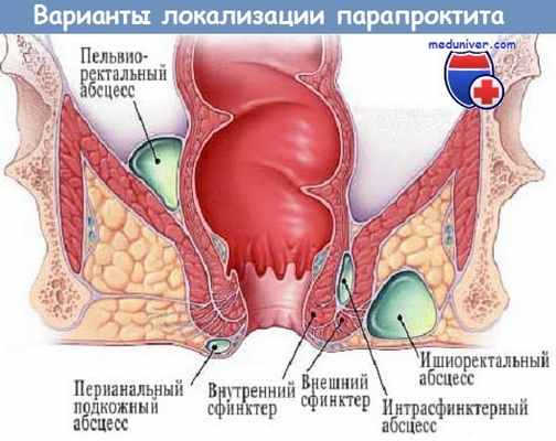 Варианты локализации парапроктита