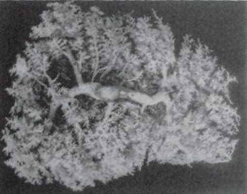 Воротная вена (коррозионный препарат)