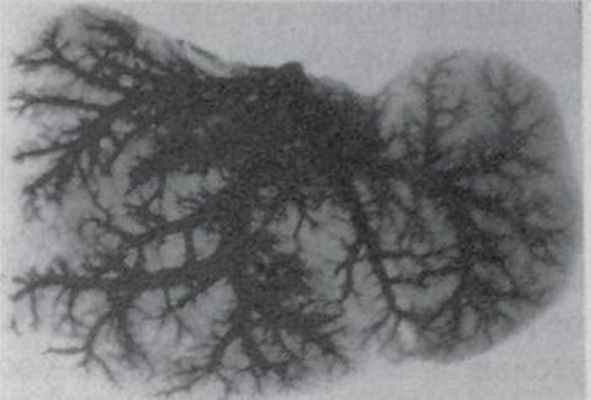 Вены печени (коррозионный препарат)