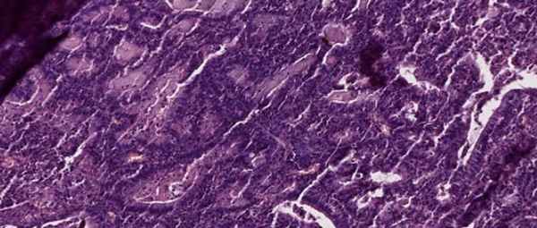 аденокарцинома эндометрия