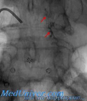 селективная эмболизация тазовых сосудов