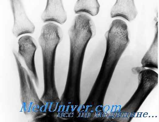 остеопороз