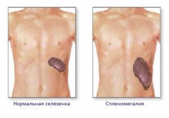 Болезнь Гоше