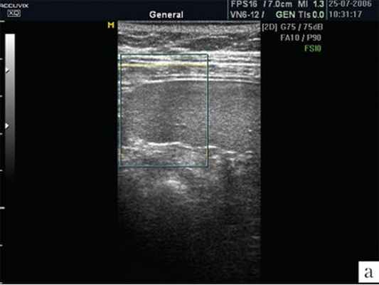 УЗИ селезенки в обычном режиме