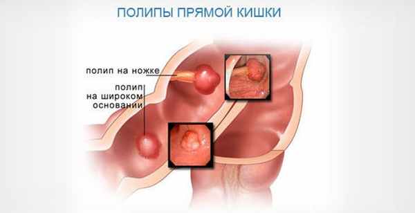 полипы прямой кишки