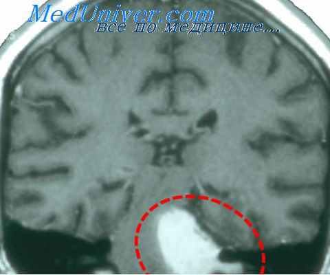 поражение блуждающего нерва