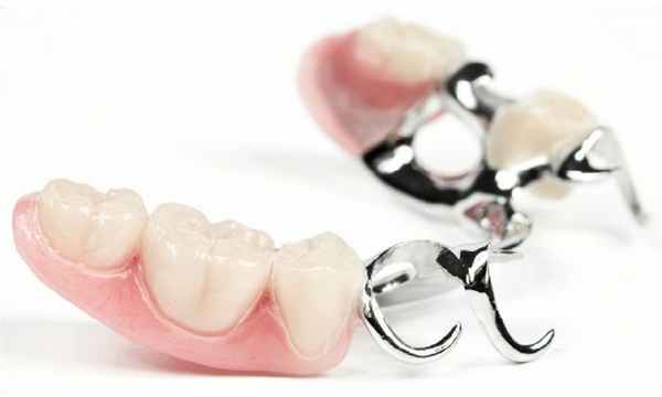 Мостовидный протез