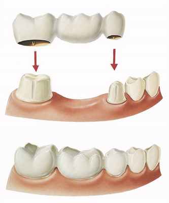 Мостовидный протез