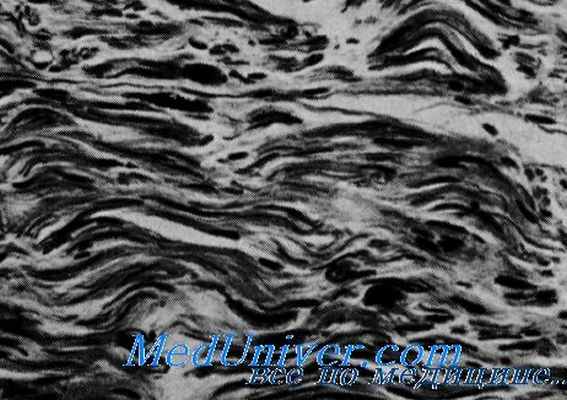 сенсорная нейропатия